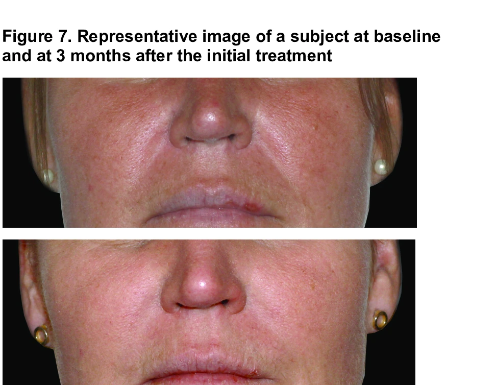 Figure 7. Representative image of a subject at baseline and at 3 months after the initial treatment