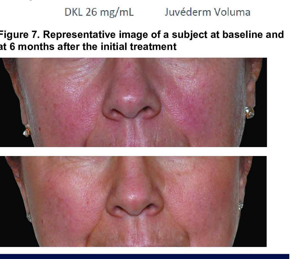 Figure 7. Representative image of a subject at baseline and at 6 months after the initial treatment